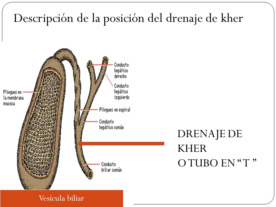 drenaje kehr complicaciones de diabetes drenaje kehr complicaciones de diabetes
